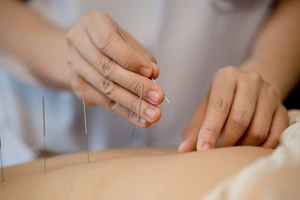 Acupuntura a domicilio